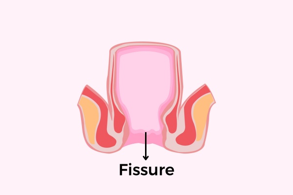 Fissure