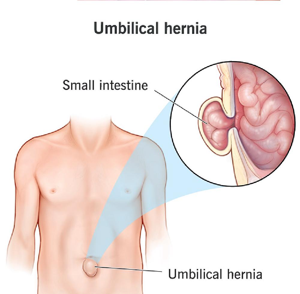 Umbilical Hernia Treatment