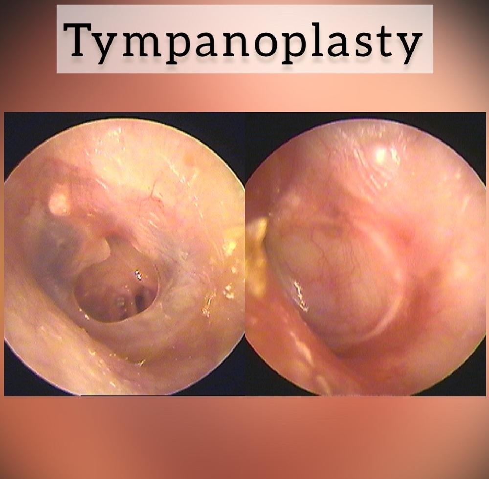 Tympanoplasty