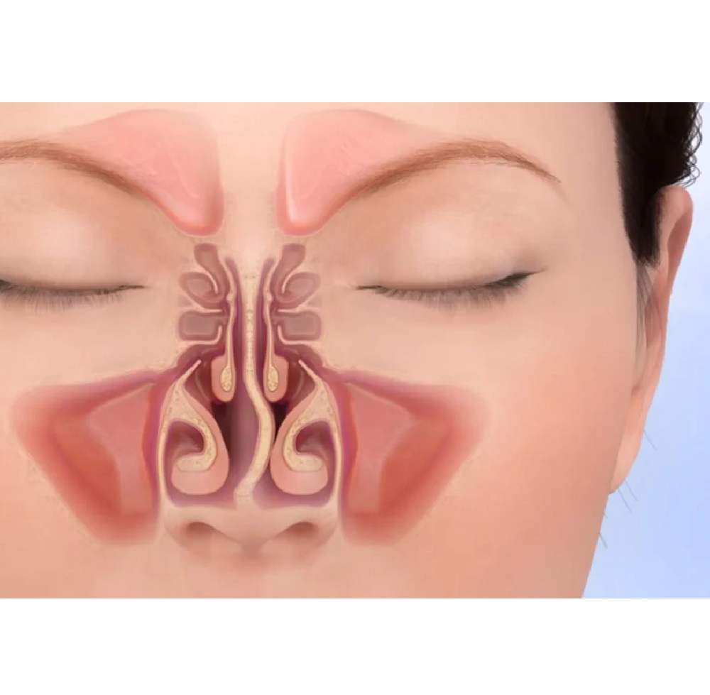 Septoplasty