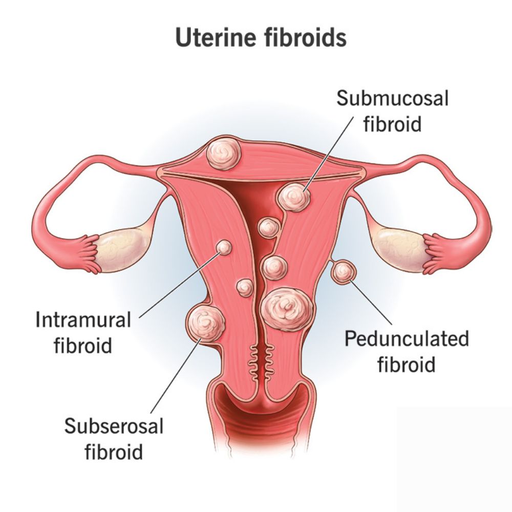 Uterine FIbroids