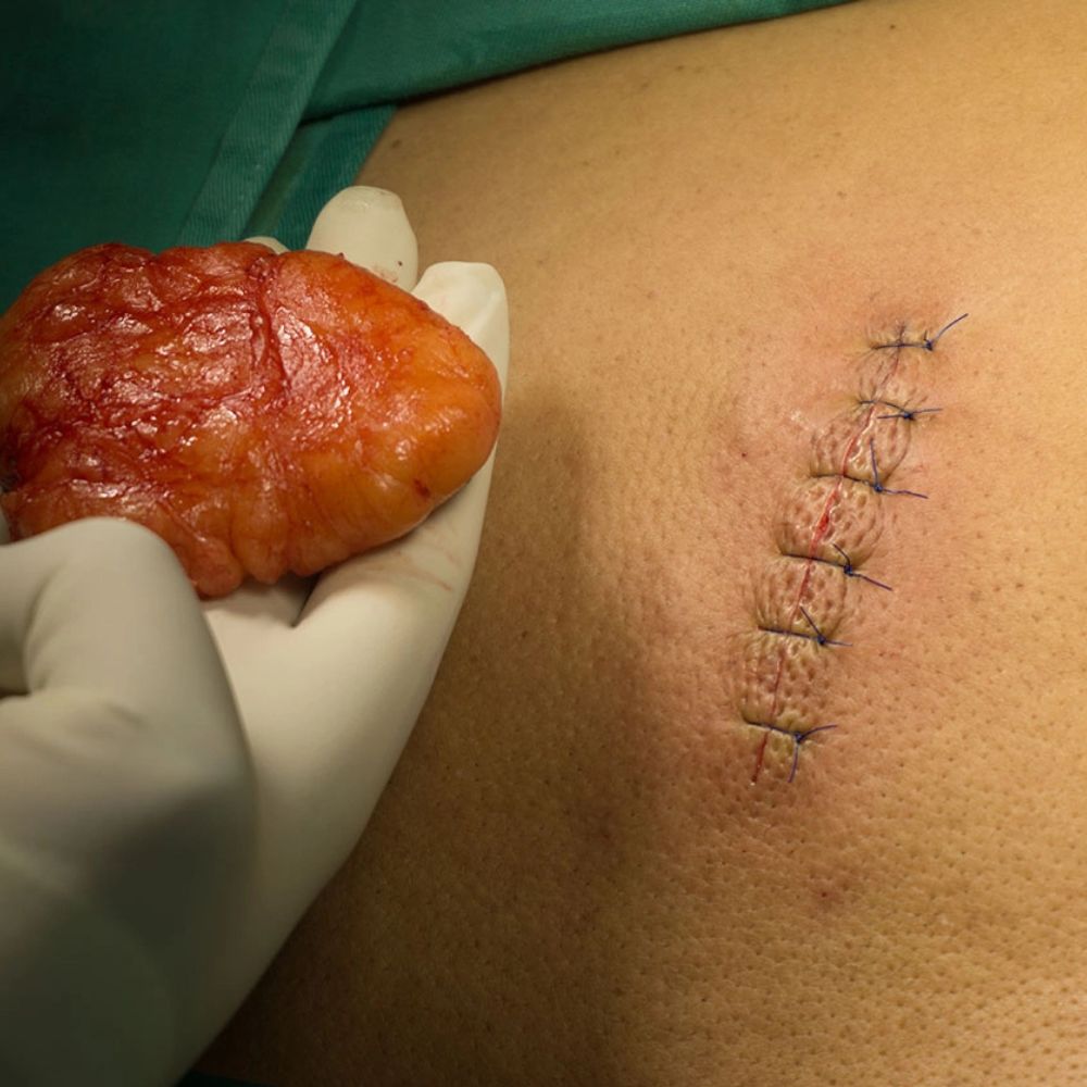 Lipoma Surgery