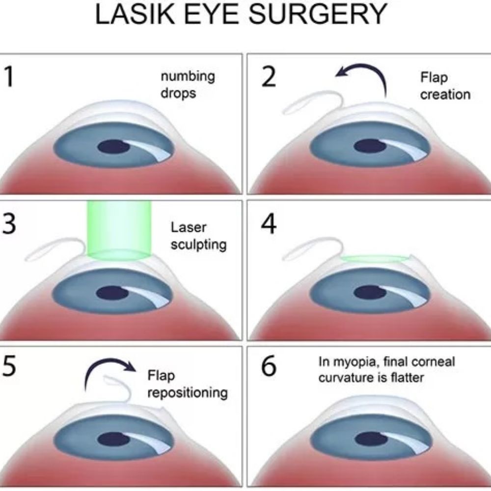 LASIK Eye Surgery In Delhi NCR