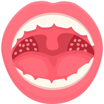 Tonsillectomy