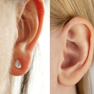 Earlobe Repair