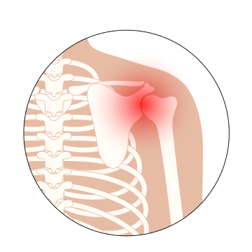 Shoulder Dislocation