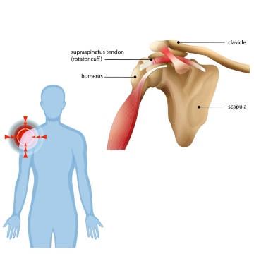 Rotator Cuff Repair