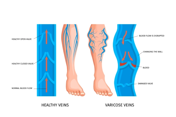 Vein Conditions